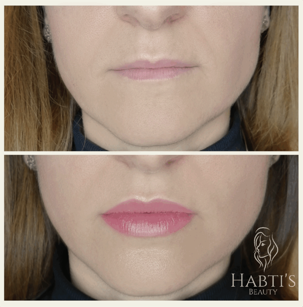 Lippen aufspritzen Berlin Natürlich Lippen aufspritzen Berlin Lippenunterspritzung Berlin