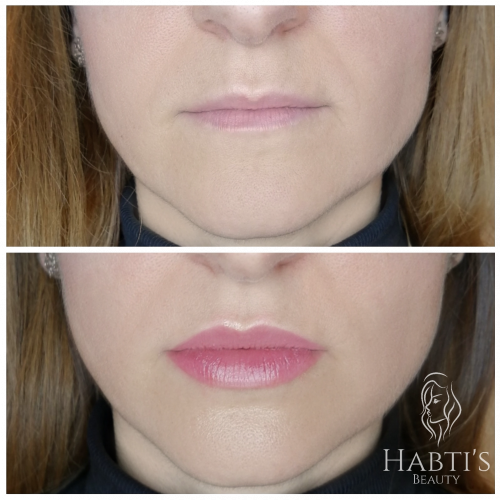 lippen aufspritzen berlin_642088153593 Lippen aufspritzen Berlin Natürlich Lippen aufspritzen Berlin Lippenunterspritzung Berlin